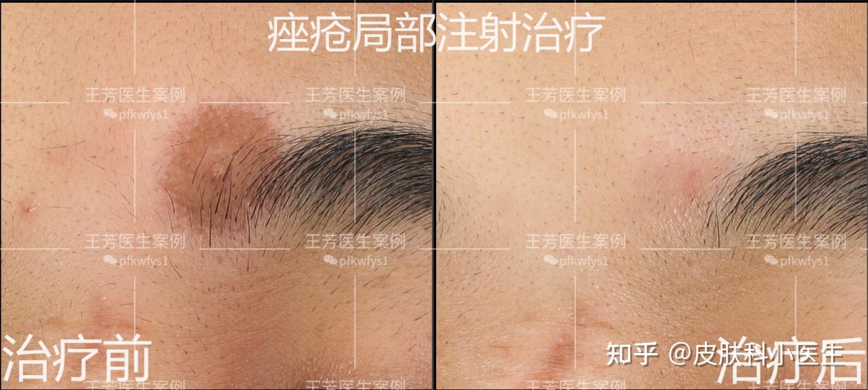 肉毒素局部注射治疗痤疮案例分享