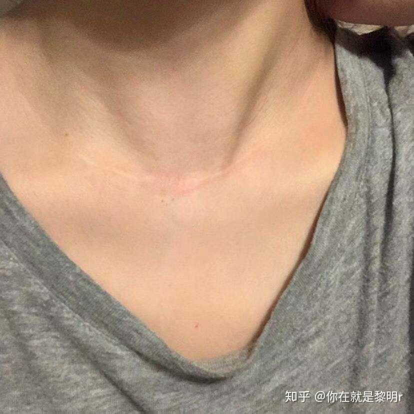 我是甲状腺右侧乳头状癌术后三年半