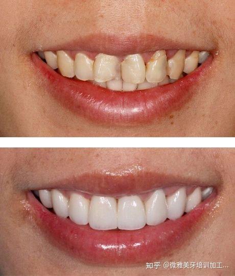 美牙贴面真的值得做吗