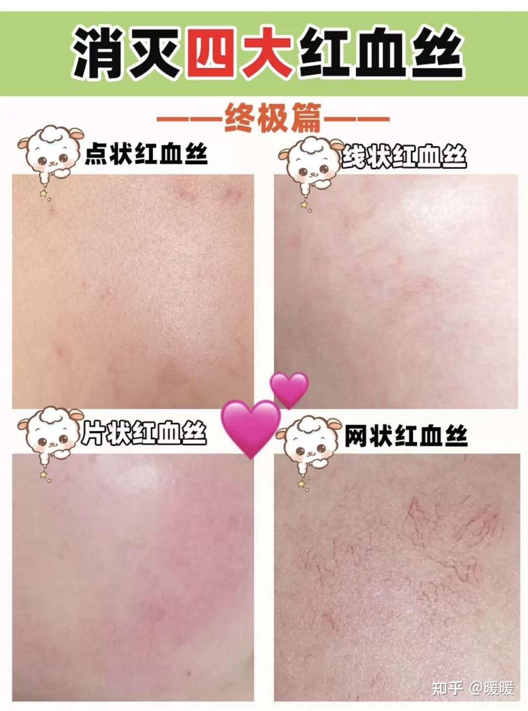红血丝护理