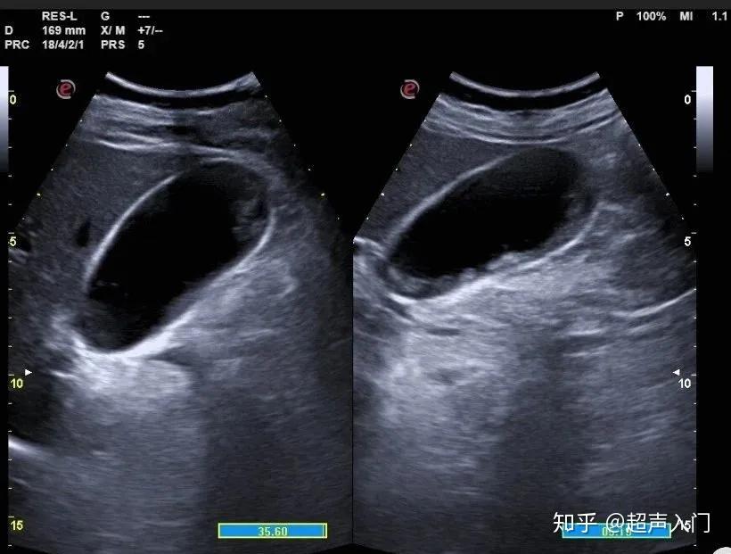 超声入门急慢性胆囊炎超声如何诊断