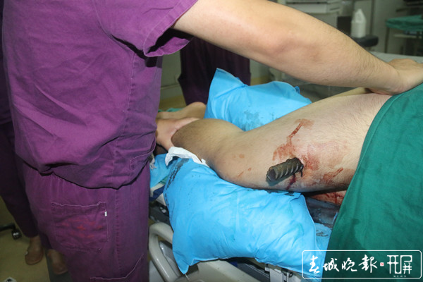 隔着屏幕都疼昆明一男子被钢筋刺中从大腿贯穿到臀部