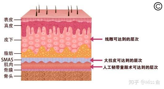 皮肤松弛下垂脂肪填充和面部提升哪个最有效改善衰老线雕黄金微雕