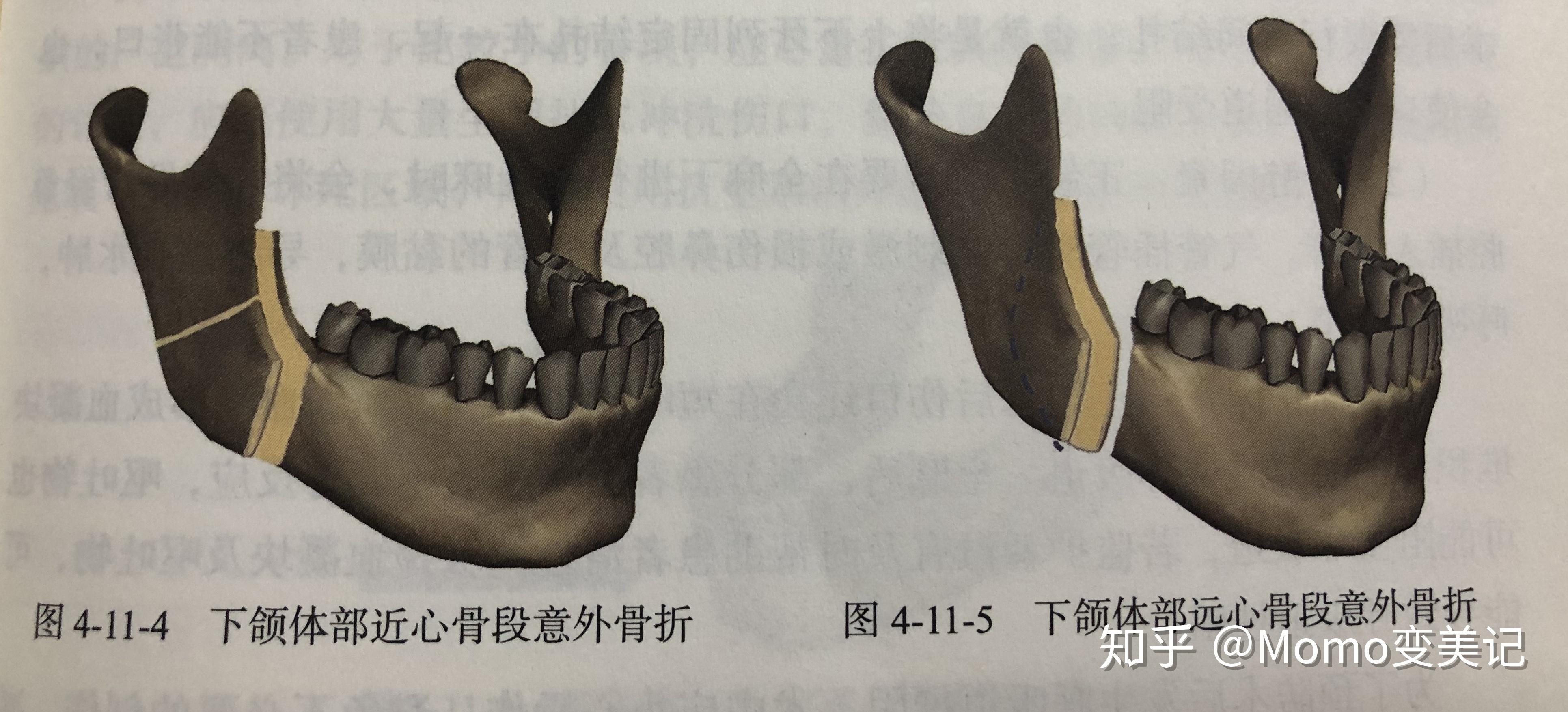 正颌手术的lefort1的上颌前推和顺旋有什么区别？ - 知乎