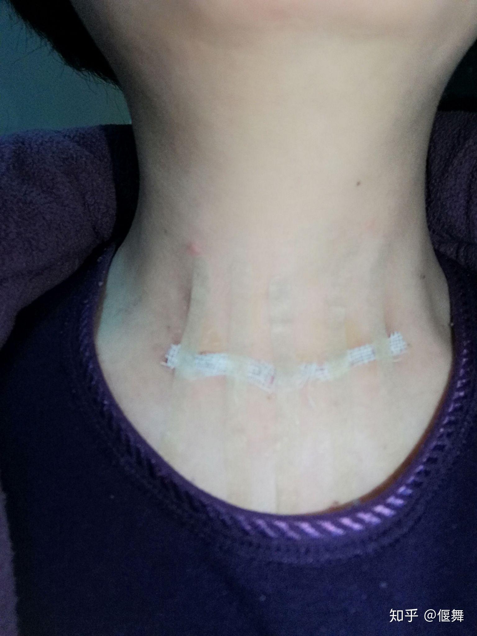 记录我的甲状腺手术伤口恢复历程