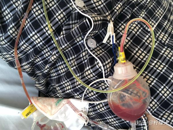 记录我甲状腺手术的过程