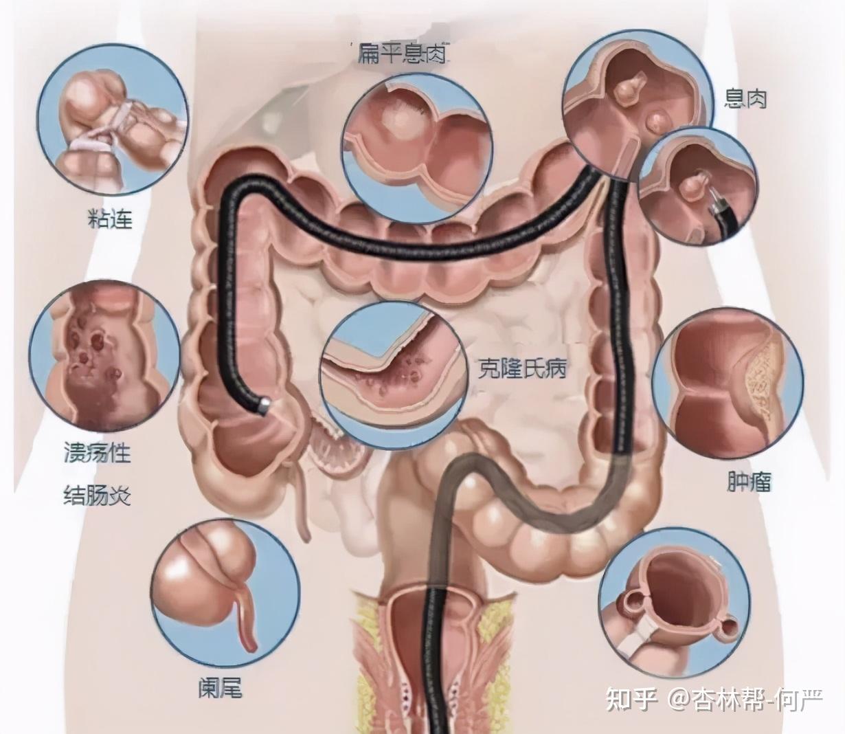 充氣裝置,通過燈光及攝像頭醫師可以查看整個大腸直至盲腸及小腸末端