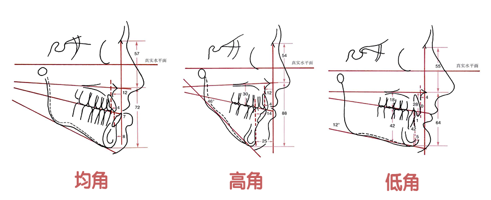 为什么要拔牙矫正不拔牙矫正丨牙套深扒