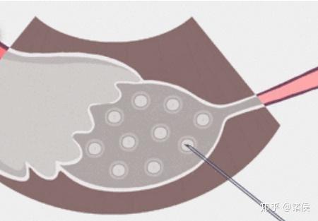 取卵手术全解析