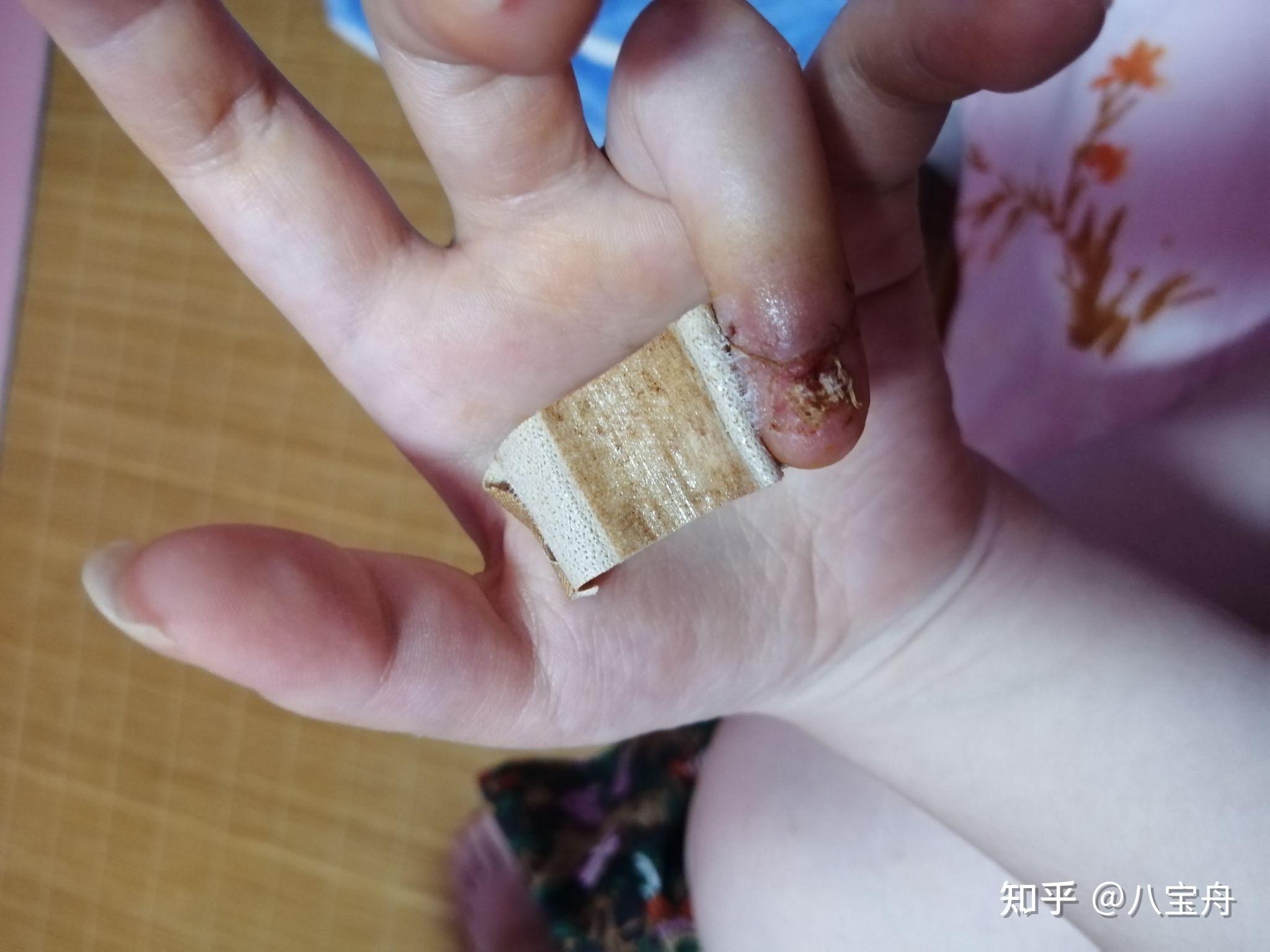 关于甲母痣手术