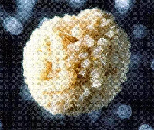 是指因可产生尿素酶的病原体感染而导致的结石,主要成分包括磷酸镁铵