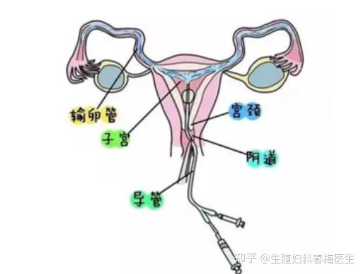 女性输卵管在哪个位置图片