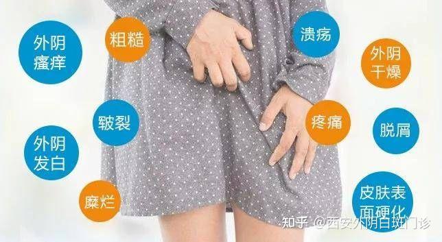 女性外阴瘙痒伴口腔粘膜症状是怎么回事？ 知乎 7720