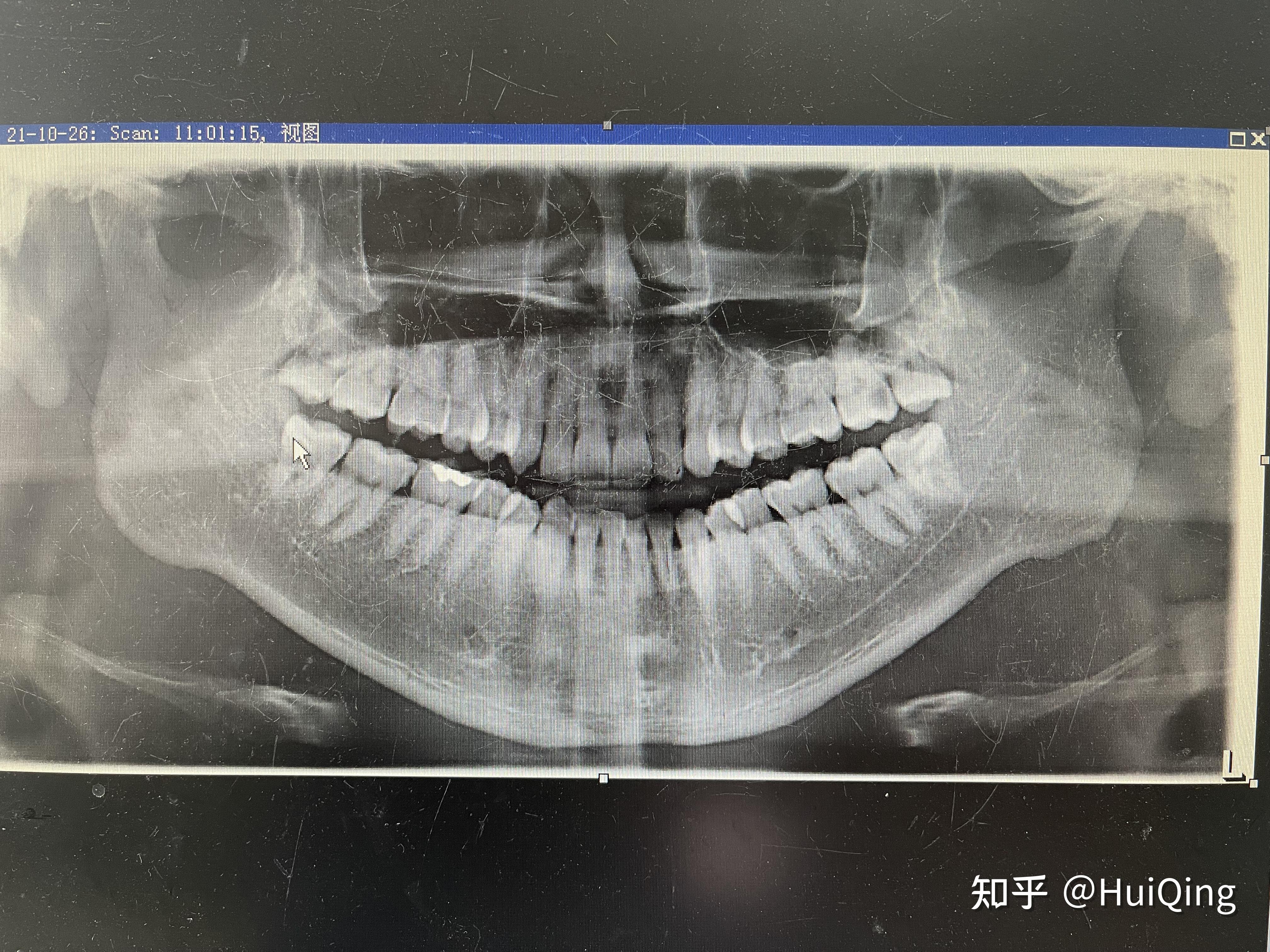 继发龋x片图片