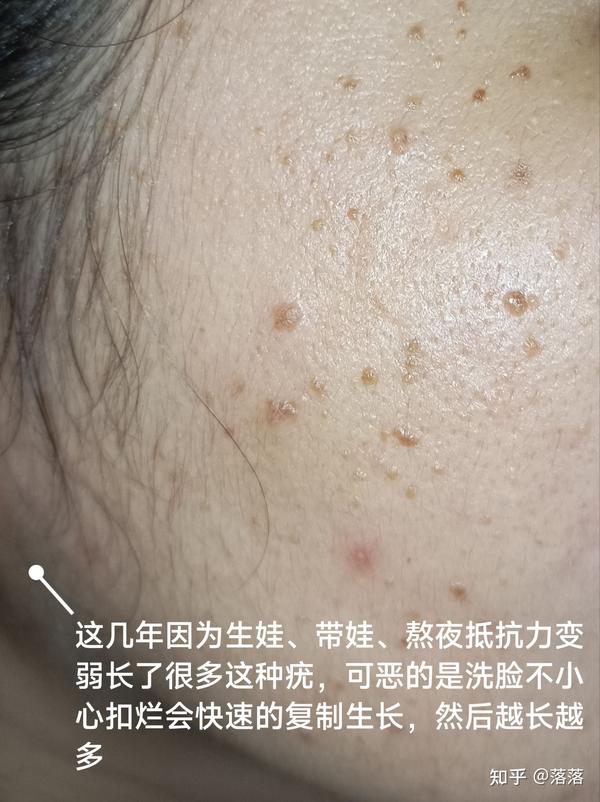 我的扁平疣丝状疣去除之路 - 知乎