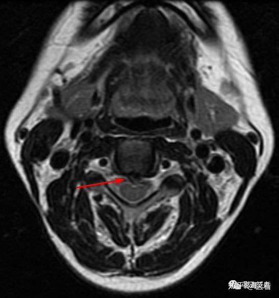 典型病例颈椎后纵韧带钙化mr