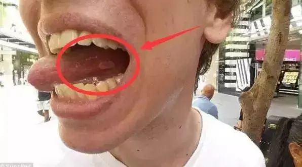 但是robinson的舌头边上,却留下了一条难看的白色疤痕.