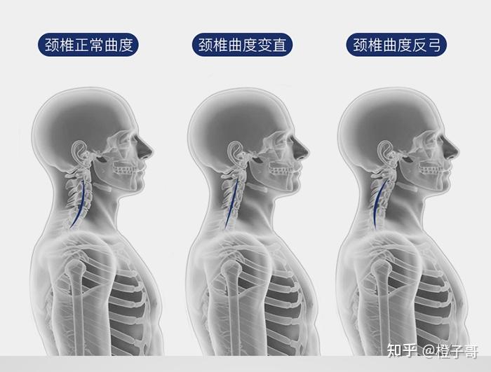 正常直立颈椎图片