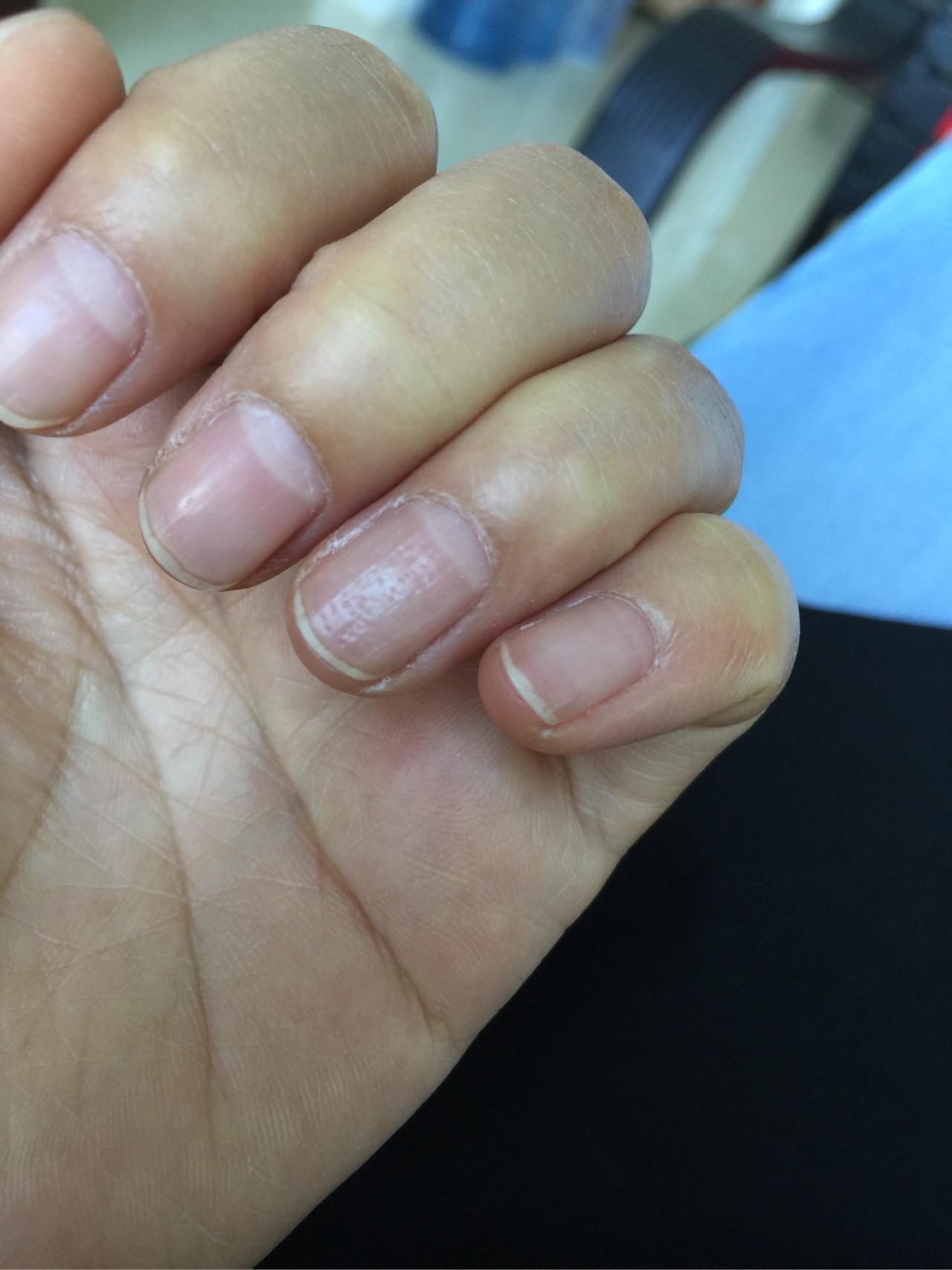 我的指甲上有很多小坑好几年了怎么回事