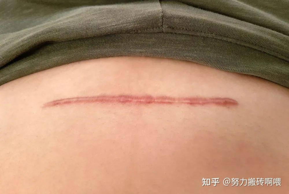 剖腹產後疤痕增生該怎麼辦