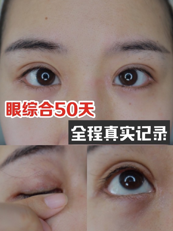 关注眼综合50天全程真实记录 1 天前 虽然现在是第50天仍然是在恢复期