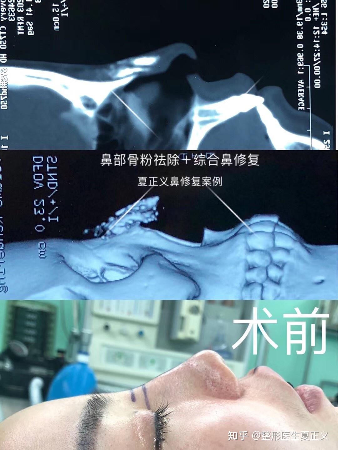 1个棘手的修复病例：1次骨粉注射+3次隆鼻手术-王旭东主治医师-爱问医生