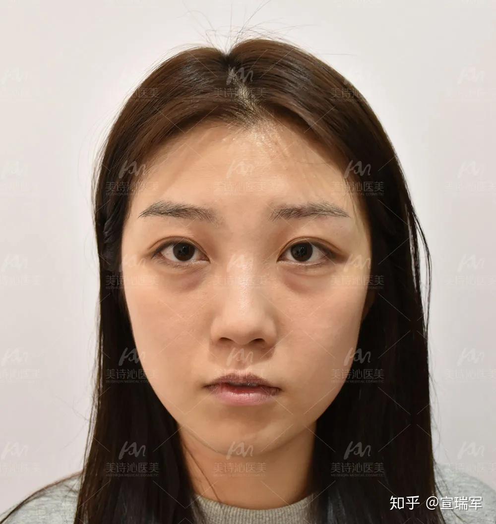 女性眼袋泪沟明显了该怎么办