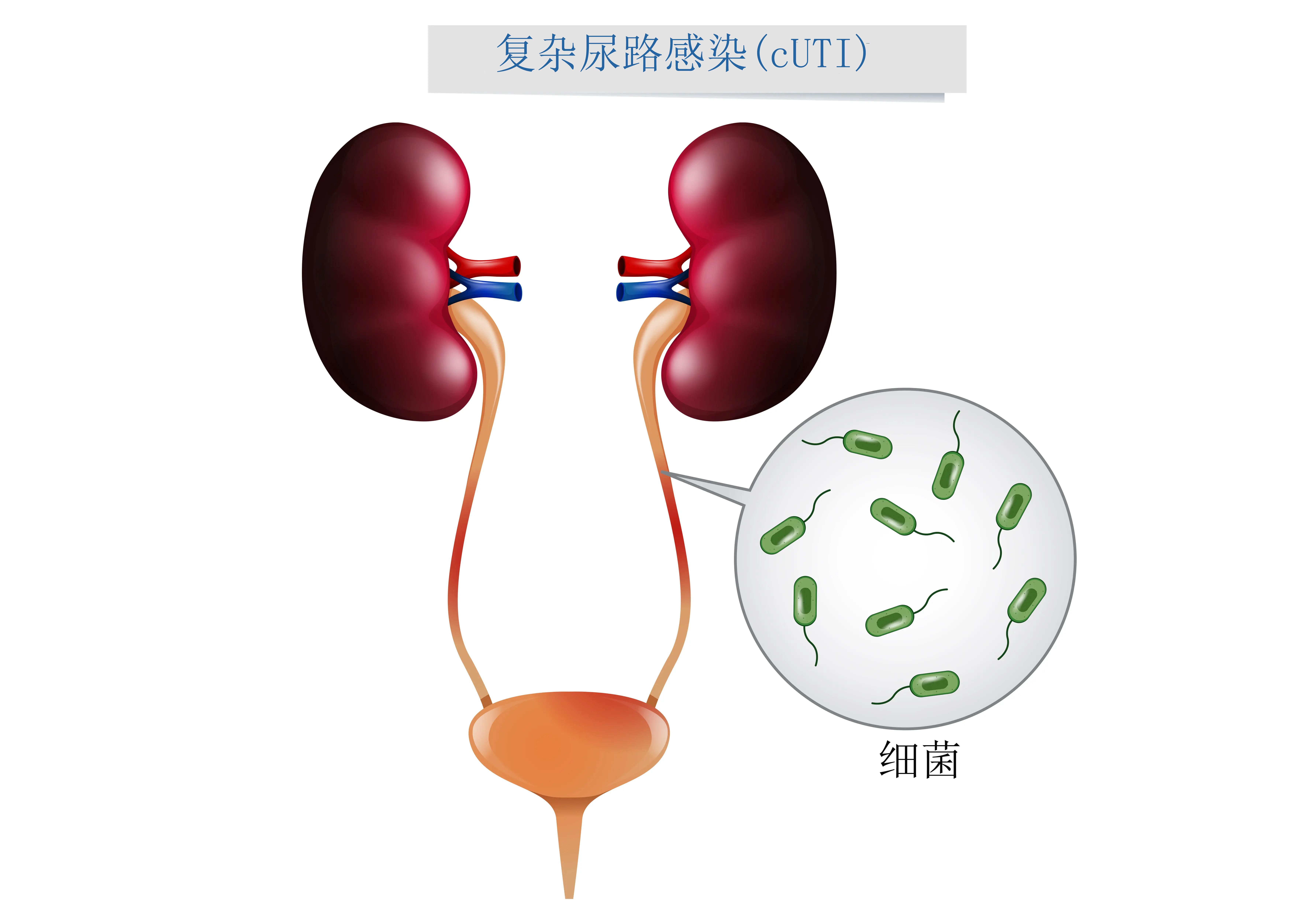 小儿复杂的腹内,尿路感染添新药!