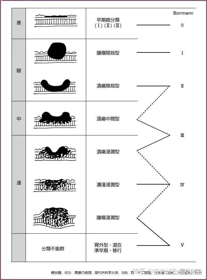 borrmann的胃癌大体分型(出自日本胃癌处理规约)对于肿瘤直接蔓延,有