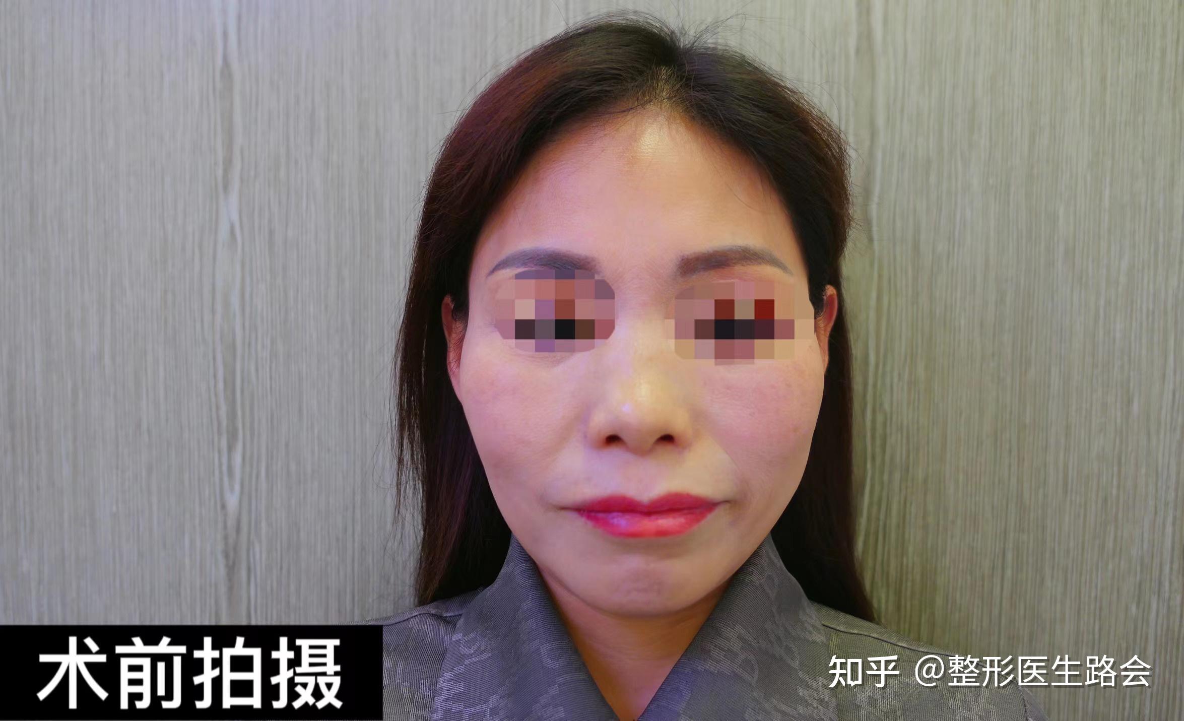 50岁的“她”，独自一人来北京做太阳穴填充，术后“惊艳”家人！ - 知乎