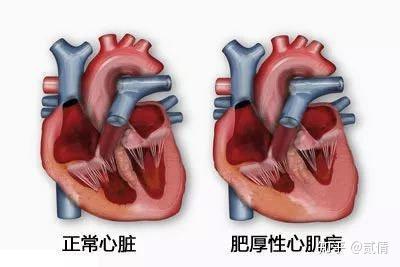 猫肥厚性心肌病 Hcm Fate Sheet 1 知乎