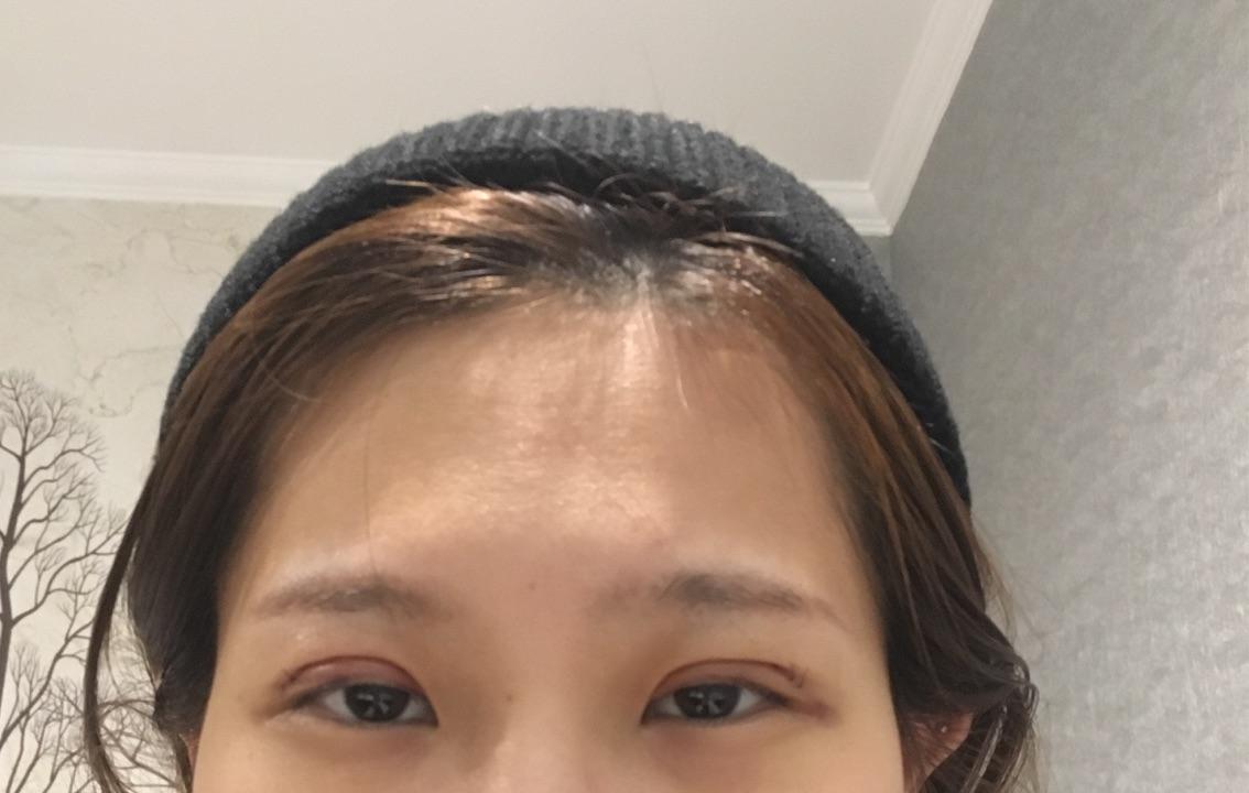割双眼皮对外貌的改变大吗？