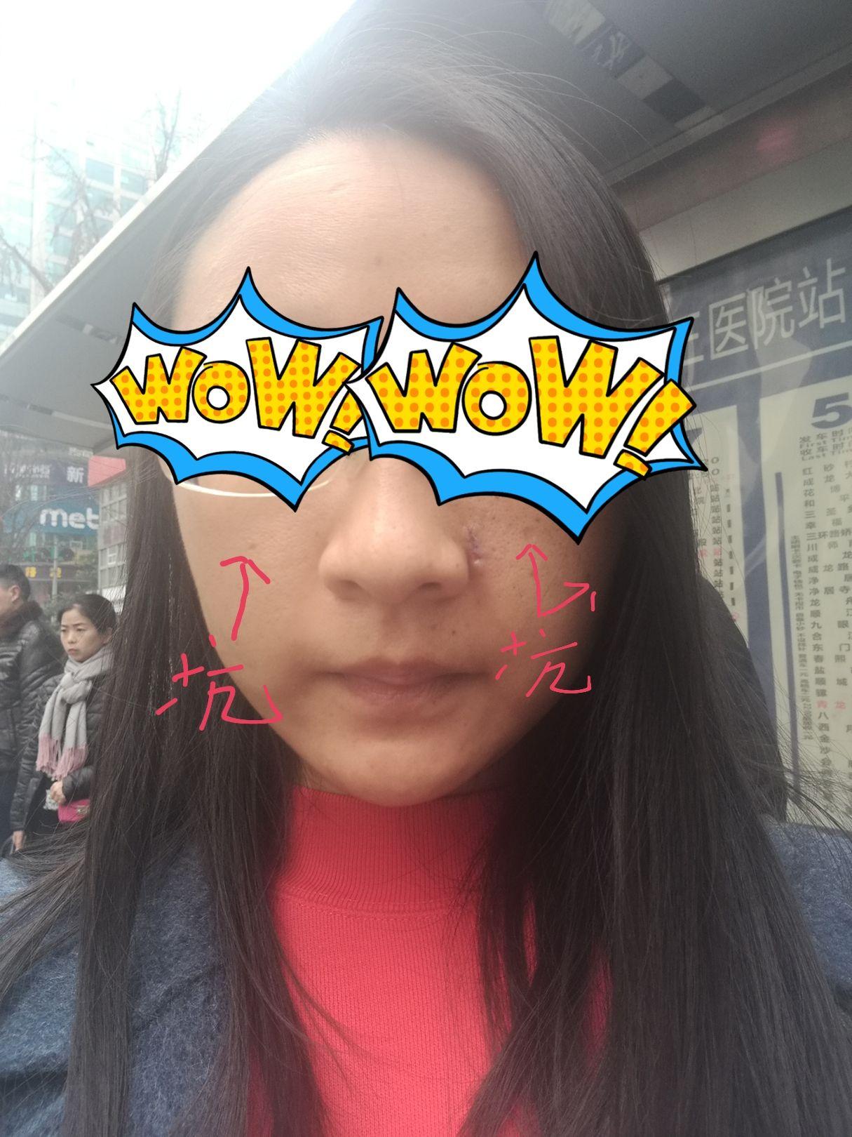 祛痣那些事儿:成都,激光祛痣+手术切痣