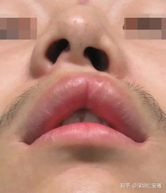 不愧是天后的女鹅唇部有缺陷又怎样还是活得又a又飒像妈妈