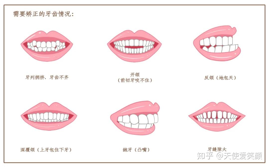牙齿不齐危害大!牙齿矫正应该从小抓起 - 知乎