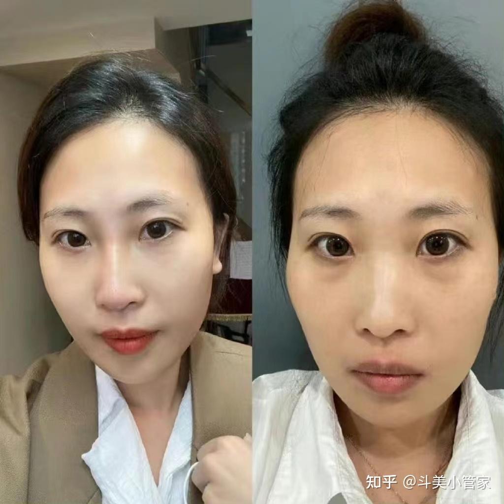 哪个效果更好更安全?新型材料少女针值得打吗?