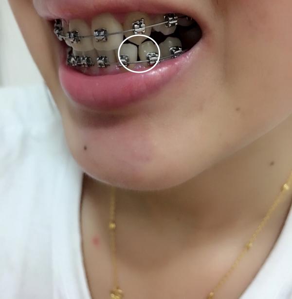 25 岁后去矫正牙齿(带牙套)是什么体验?