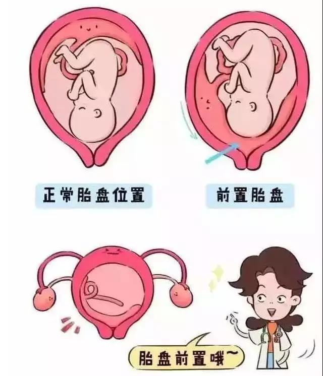妊娠晚期阴道出血 小心胎盘前置 知乎