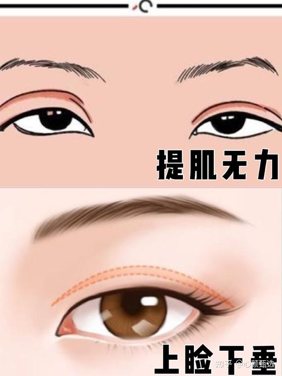 遮瞳可以理解是提肌无力,也可以说是上睑下垂.区别是什么呢?