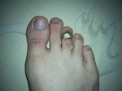 脚上为什么会长鸡眼