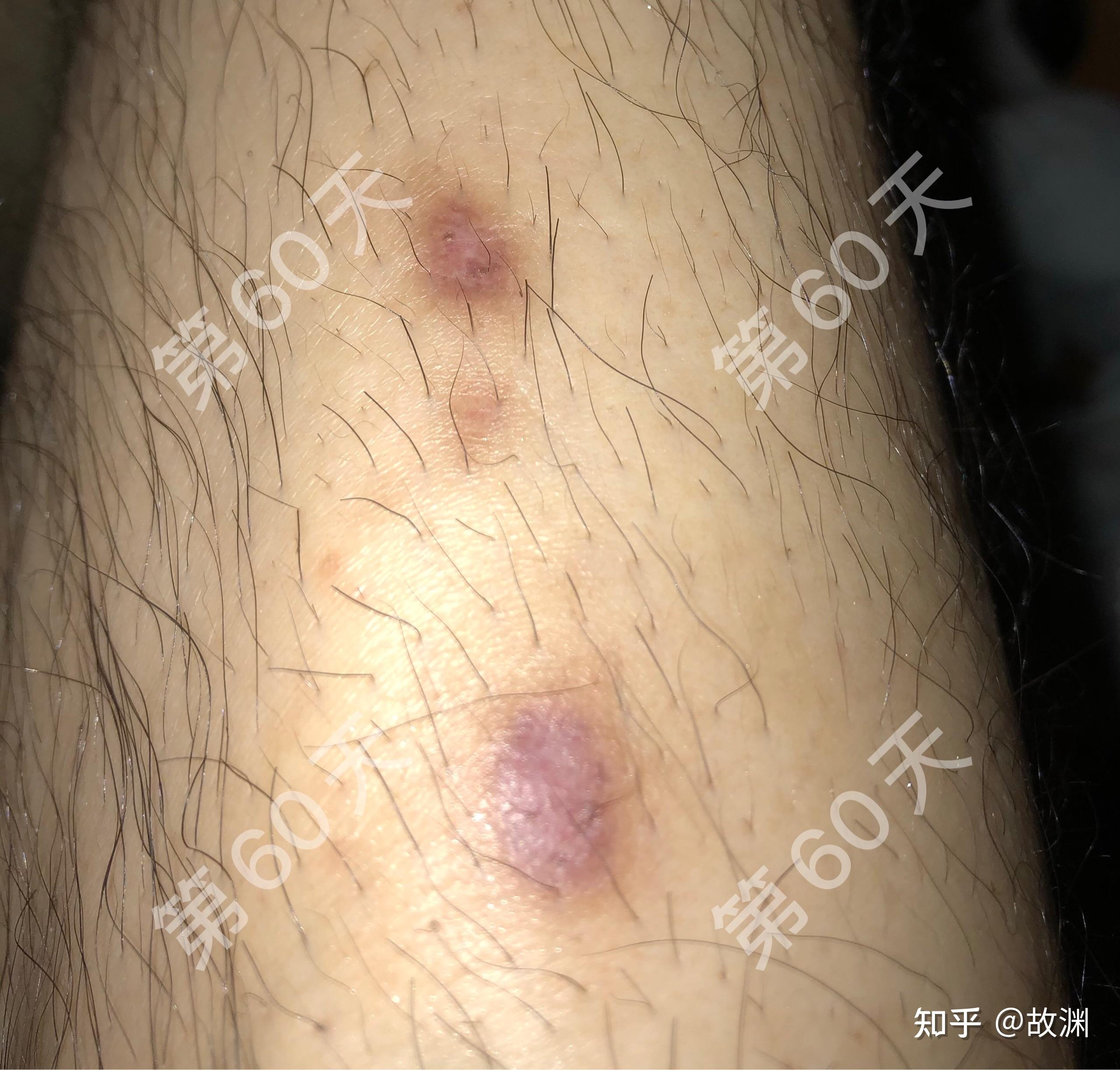 热水袋低温烫伤恢复记录(图片可能引起不适) - 知乎