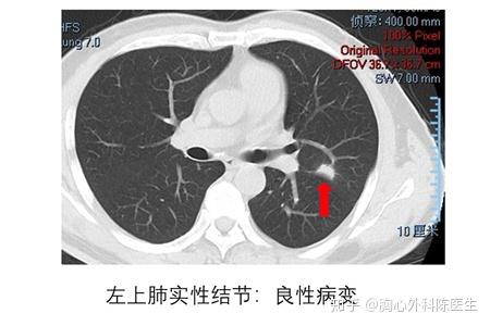 什麼是肺結節肺磨玻璃結節肺毛玻璃結節