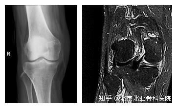 北亚特色技术 治疗中老年膝关节炎 膝关节置换和关节镜手术哪个效果更佳 知乎
