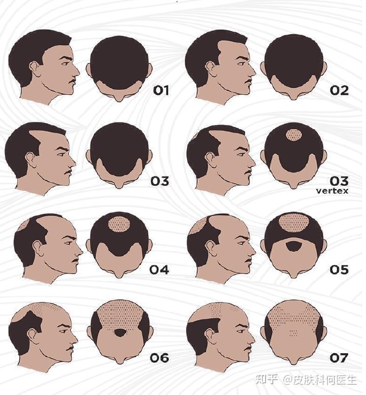 7級:為男性型脫髮最嚴重的類型.
