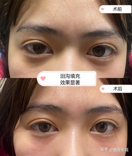 嗨体熊猫针填泪沟真香