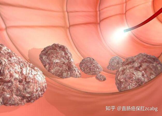 结肠 癌症状 结肠 癌症状