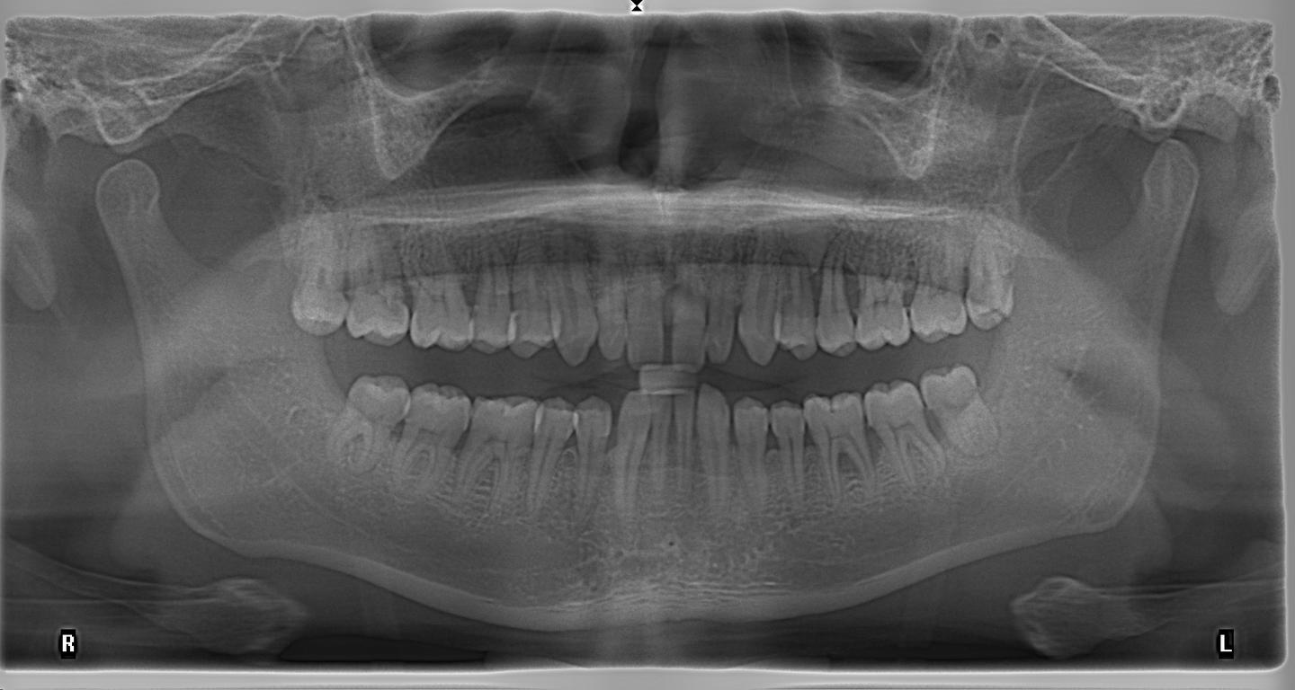 正常牙齿侧位片图片