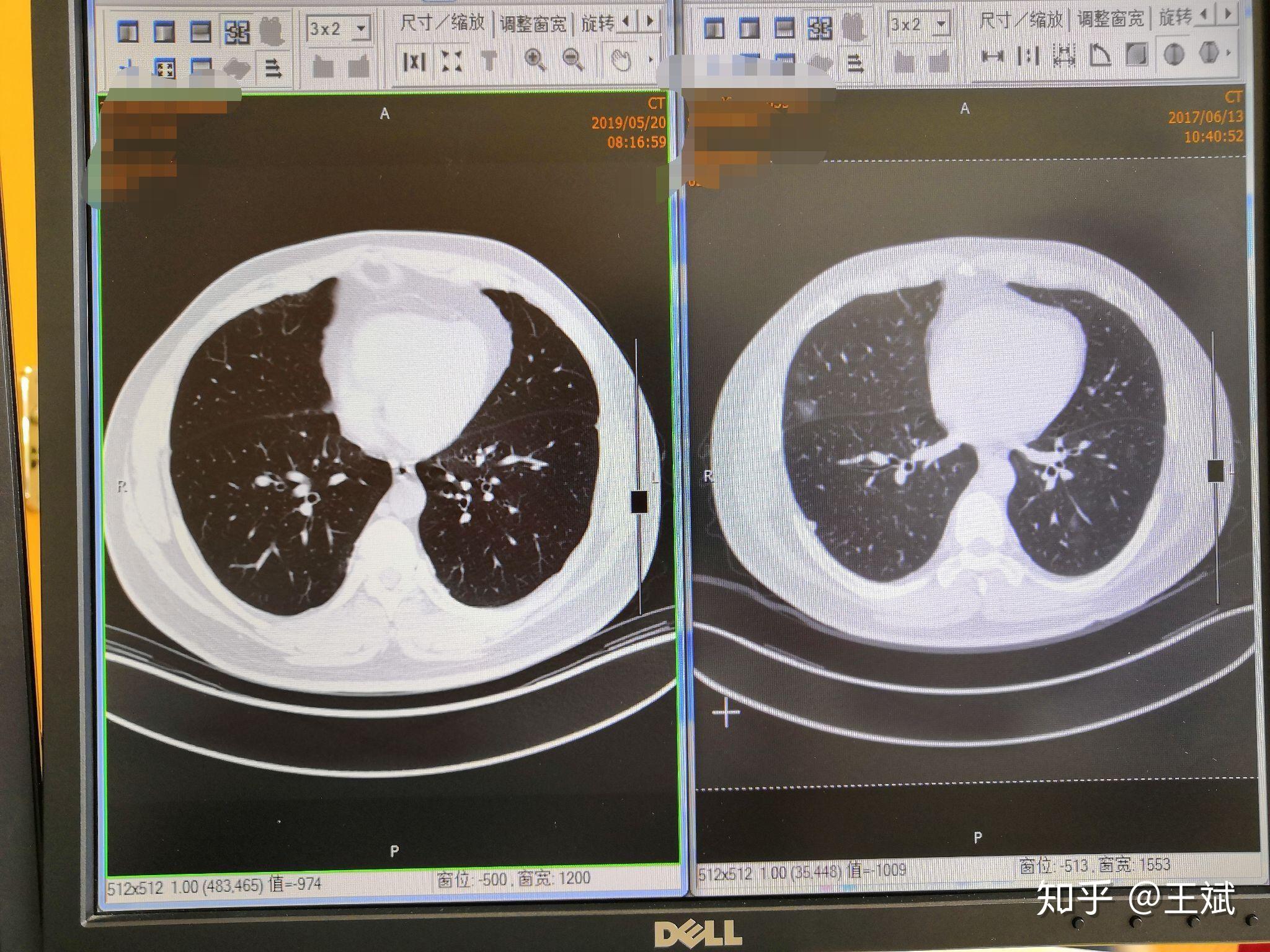 肺部结节诊断的金标准