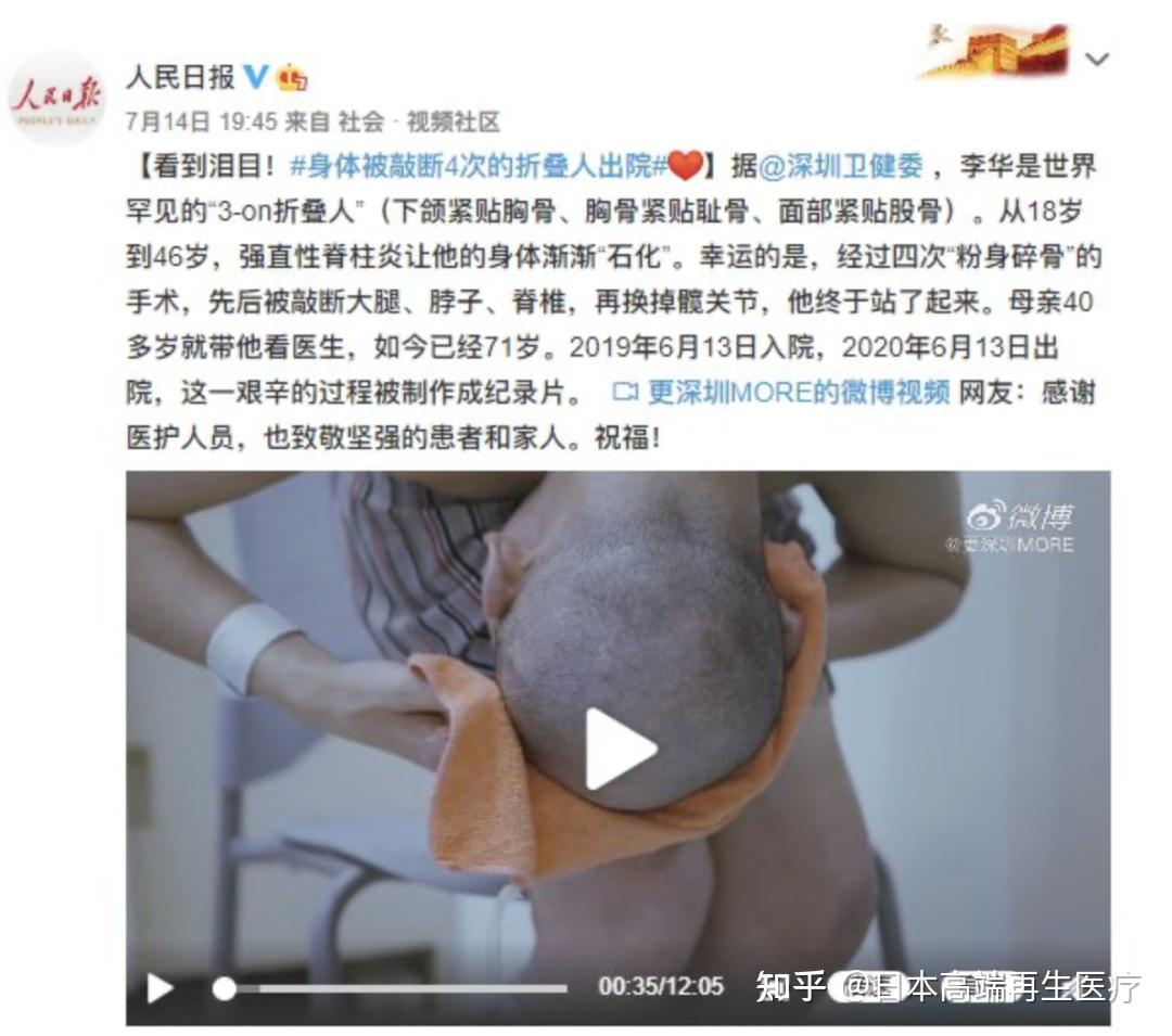 同时,还有很多熟知的明星也患有强直性脊柱炎,比如周杰伦,张嘉译等