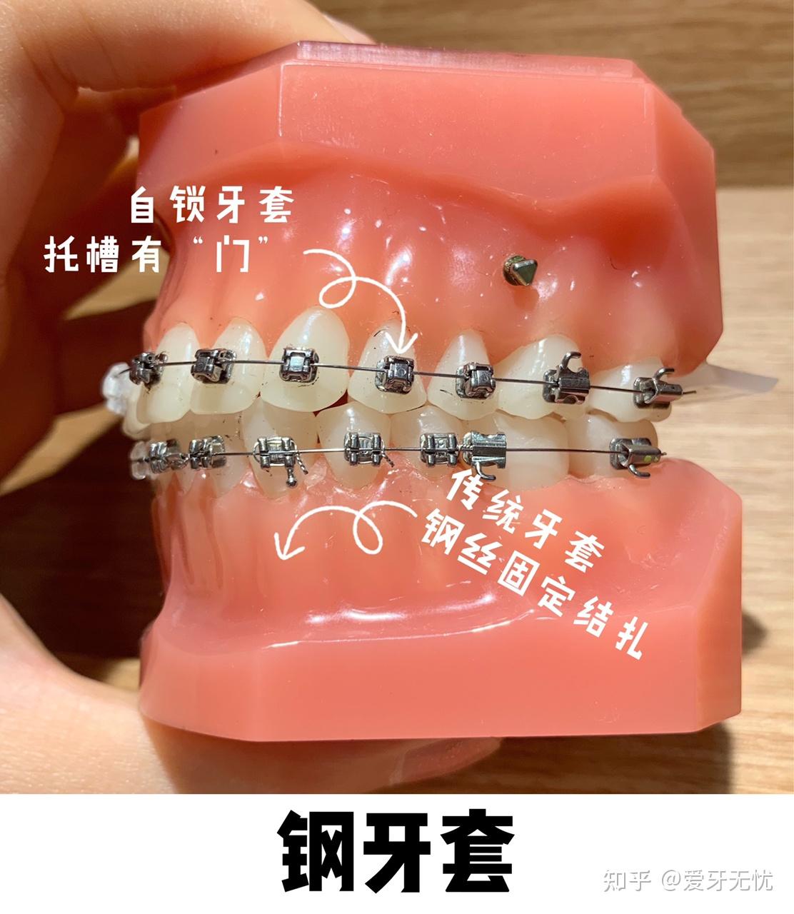 牙齿矫正的具体流程是什么?牙齿矫正价格是多少?正畸疑问全解答 - 知乎